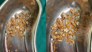 Kidney Stones: What You Should Know