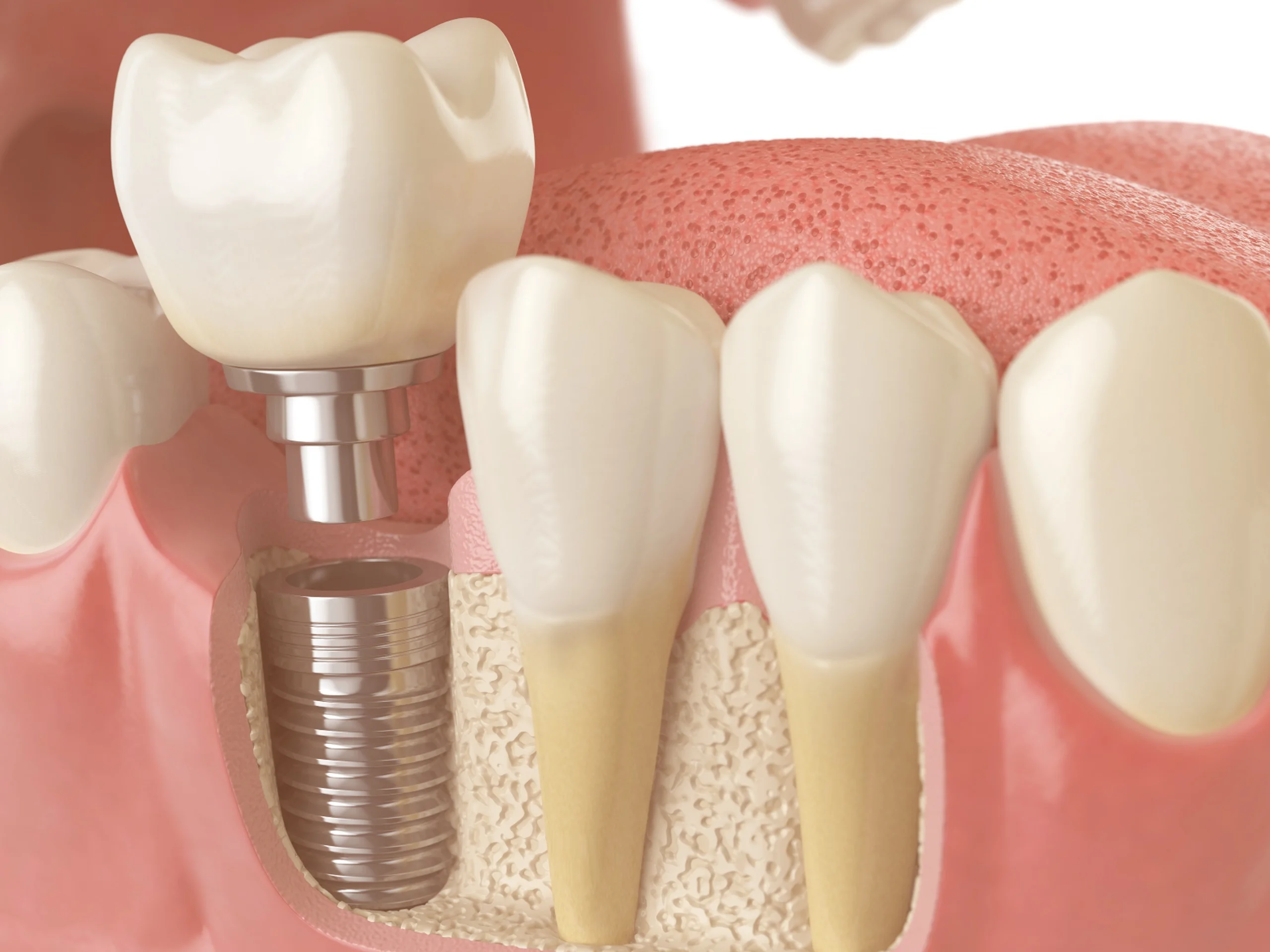 bone graft tooth extraction