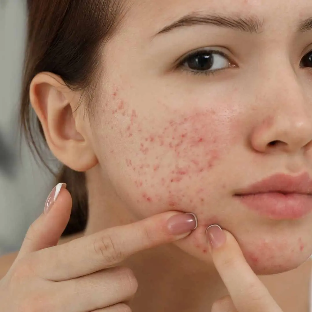 Persistent Acne Breakouts: Simplify Skincare and Avoid Picking